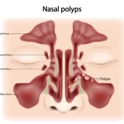 Nasal polyps illustration