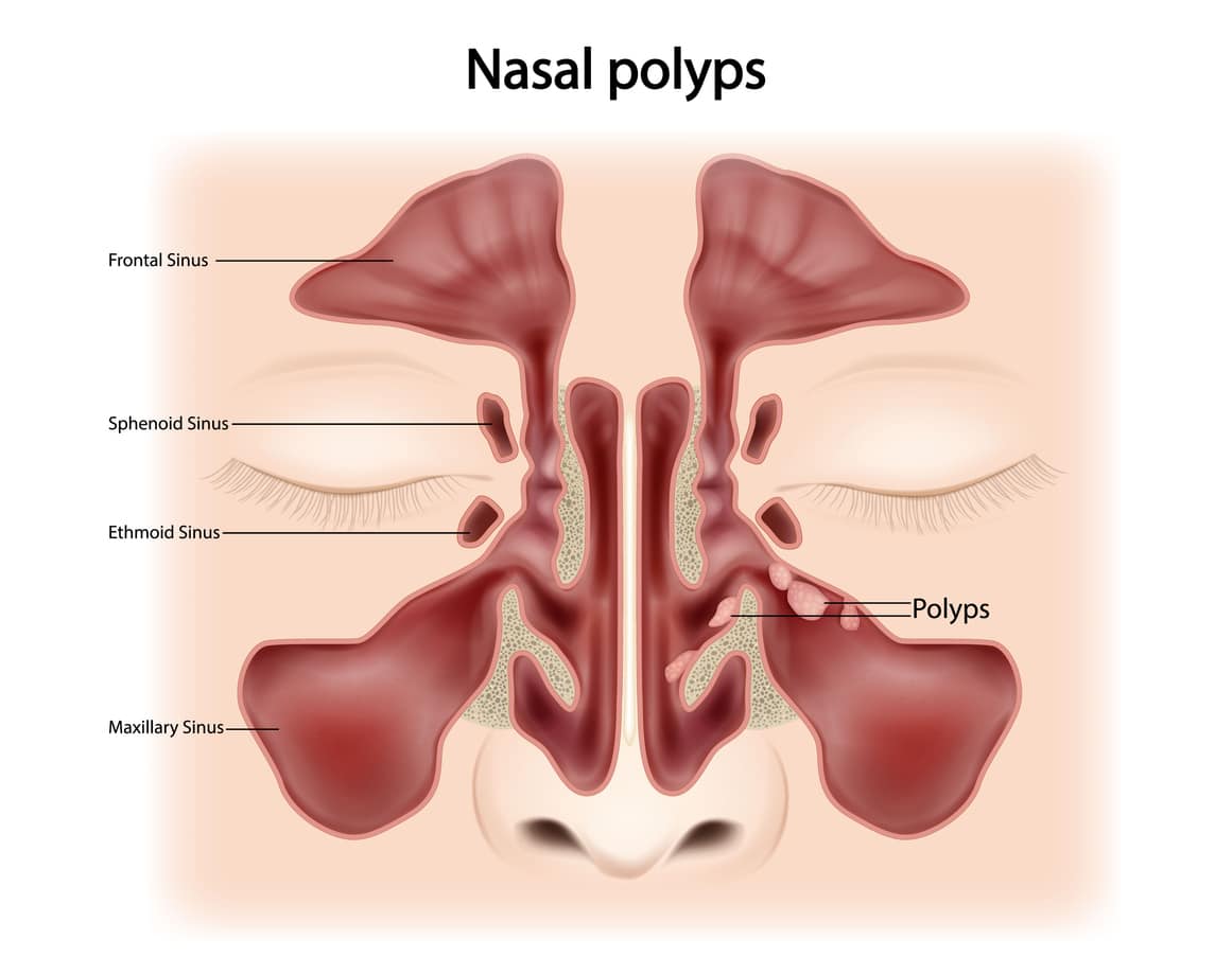 Nasal polyps illustration