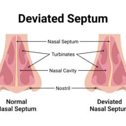 Deviated septum illustration